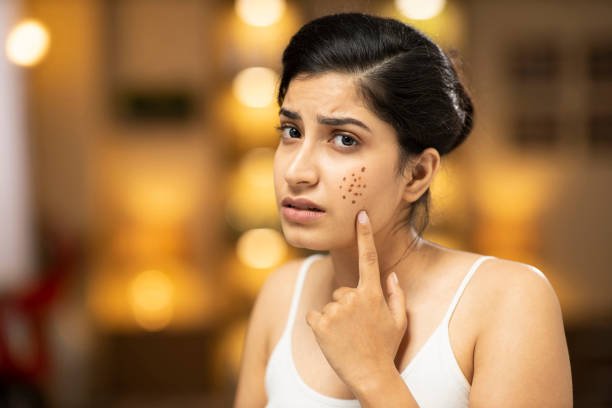 Acne & Pimple Care