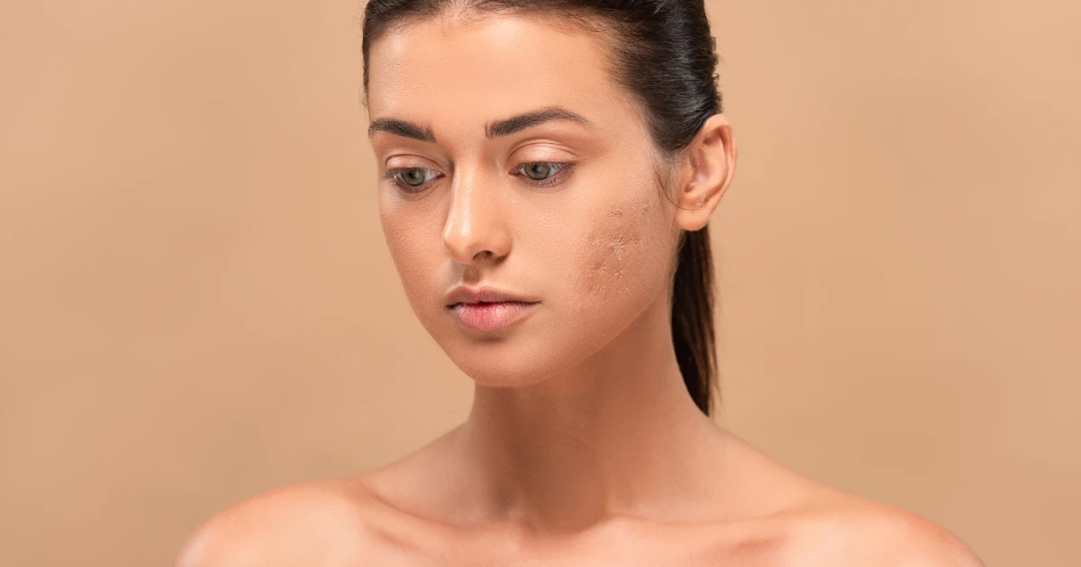 Acne Marks & Scar Guidance